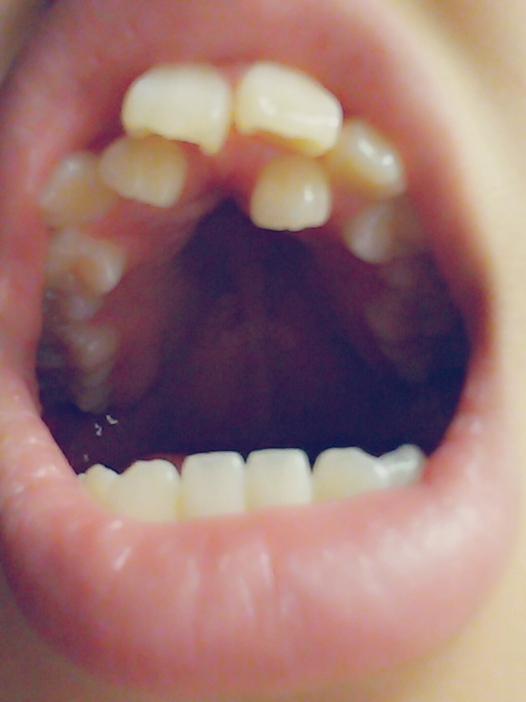 悪い 歯並び