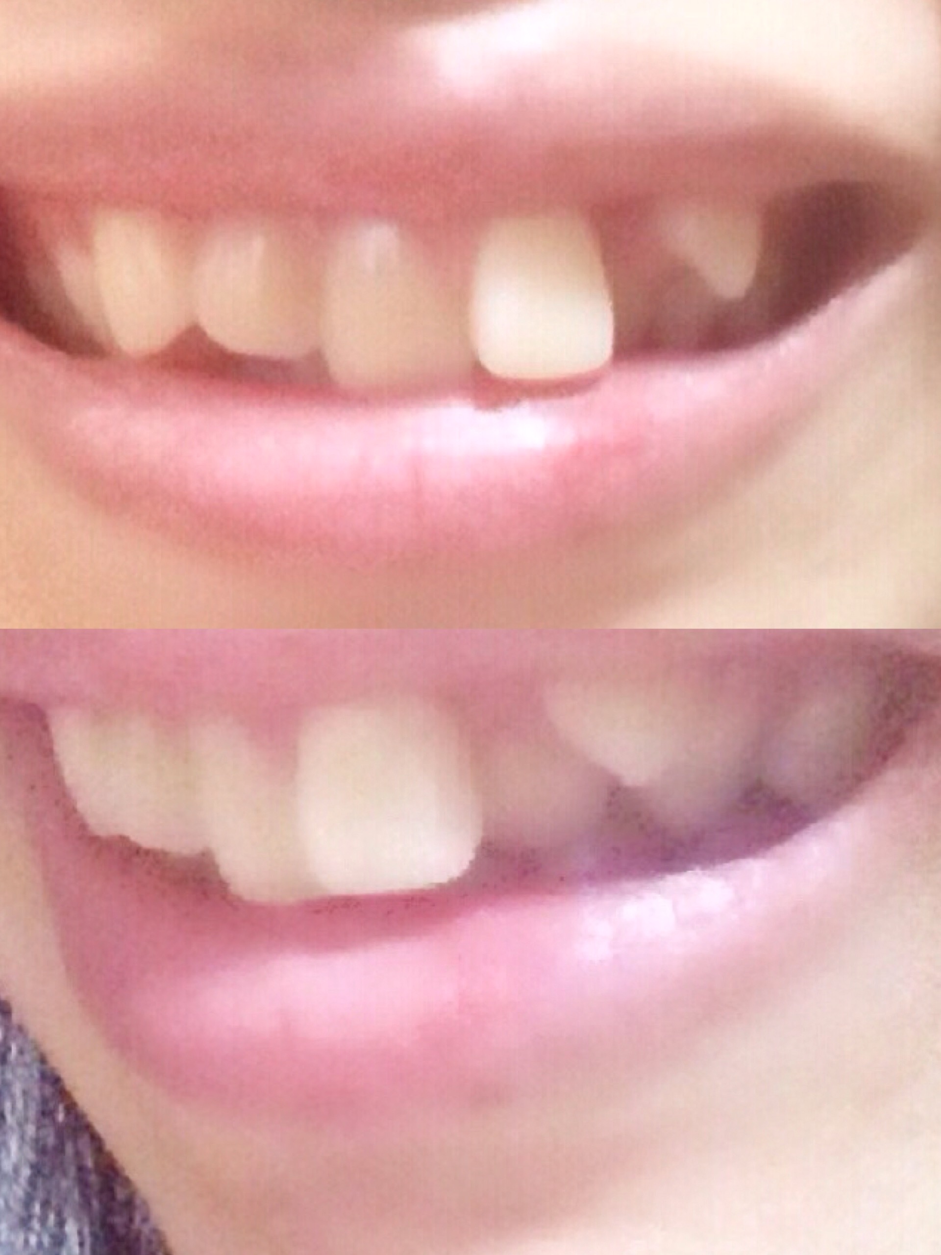 [写真あり] 左上1番が前に出て八重歯あり。歯列矯正は可能ですか？ 歯チャンネル歯科相談室