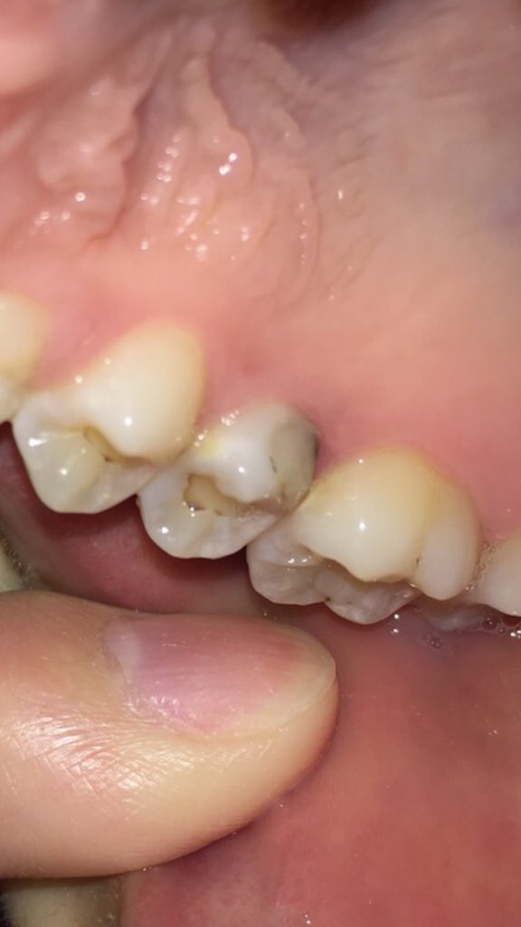 写真あり 受診予定だが奥歯の根元が黒く虫歯と思います 歯チャンネル歯科相談室