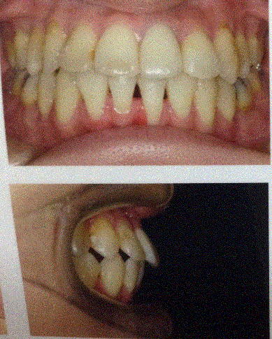 写真あり 歯列矯正後のリテーナーになったが出っ歯になっている 歯チャンネル歯科相談室