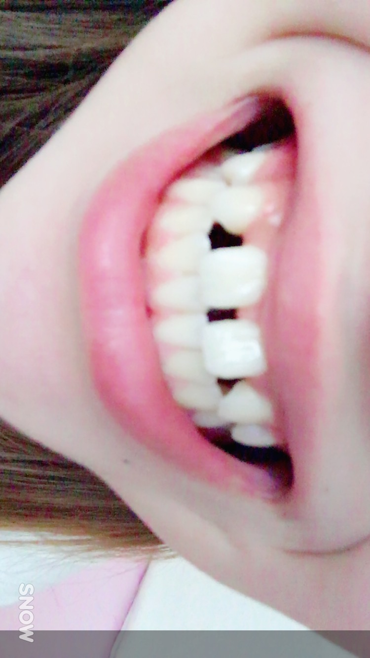 乳歯 すき っ 歯