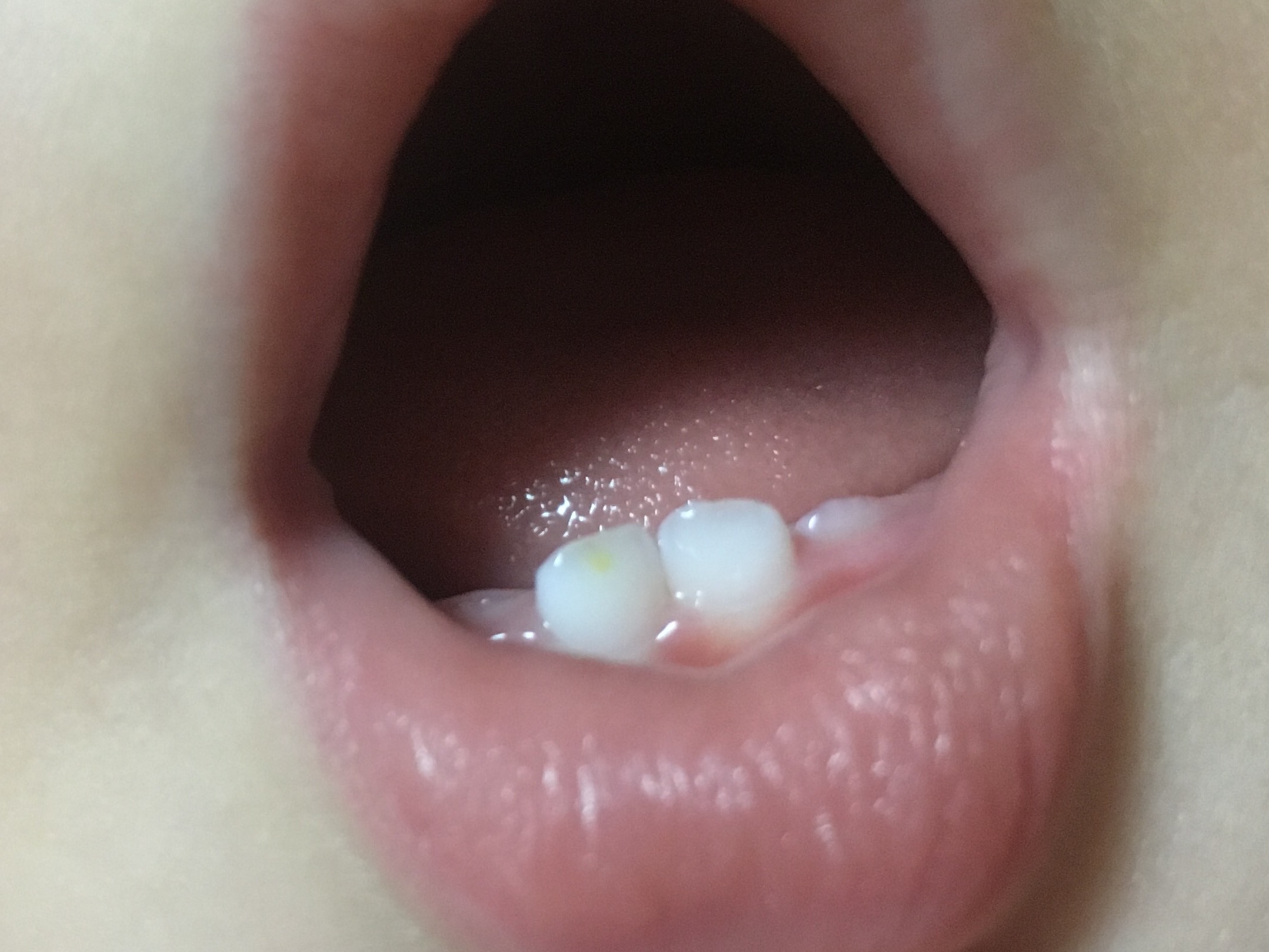 舌 黄色 赤ちゃん 舌が黄色い原因は？症状や病気の可能性について紹介！