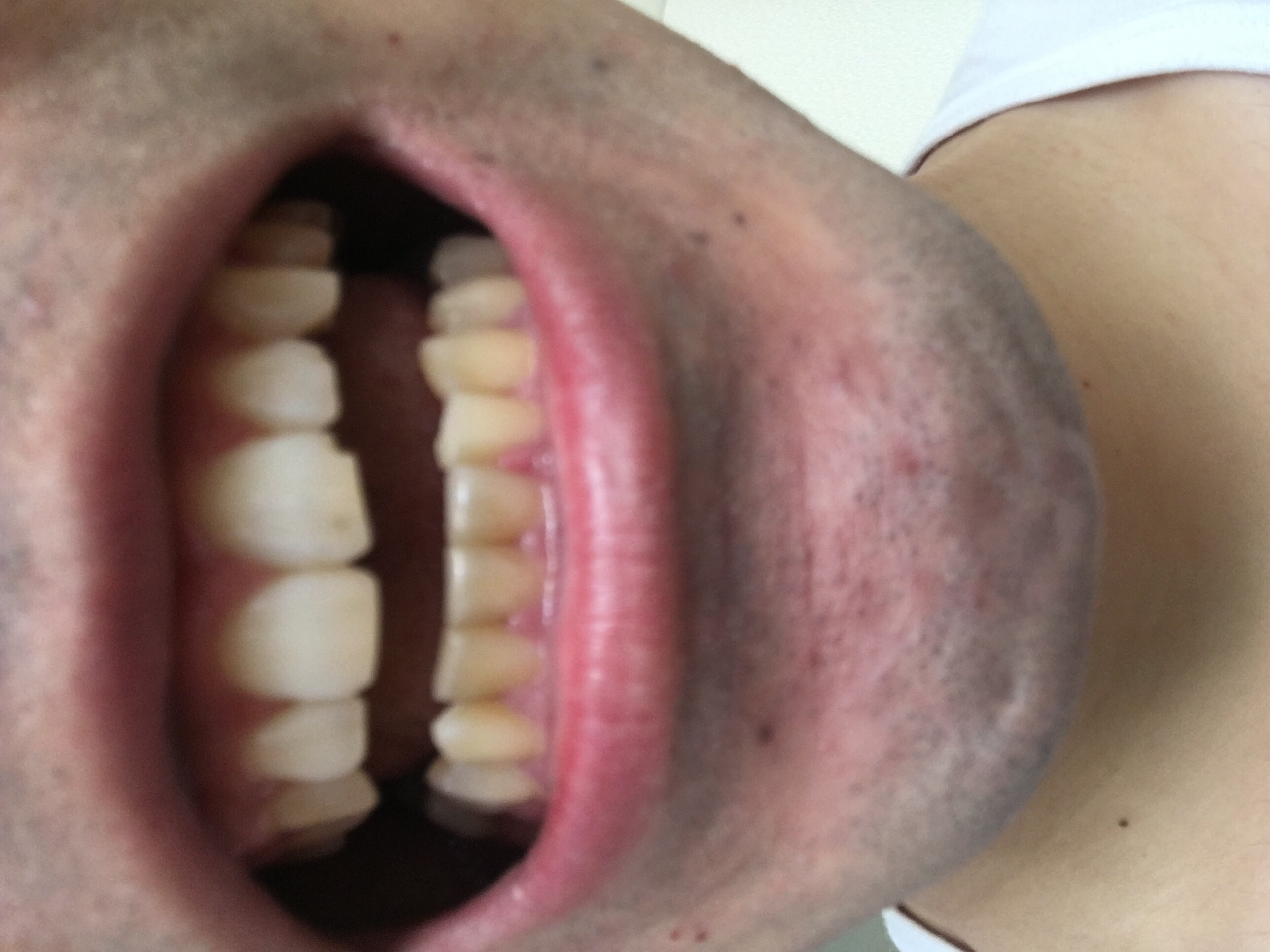 [写真あり] 前歯が出っ歯で奥歯がすきっ歯。ヒビも気になり不安だらけ