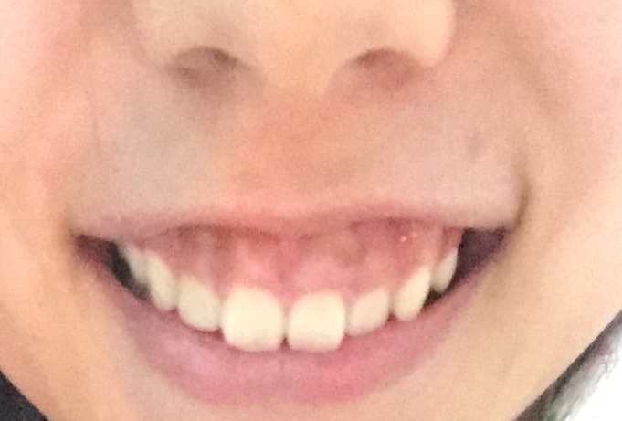 写真あり 歯よりも歯茎の見える面積が広いガミースマイル 歯チャンネル歯科相談室