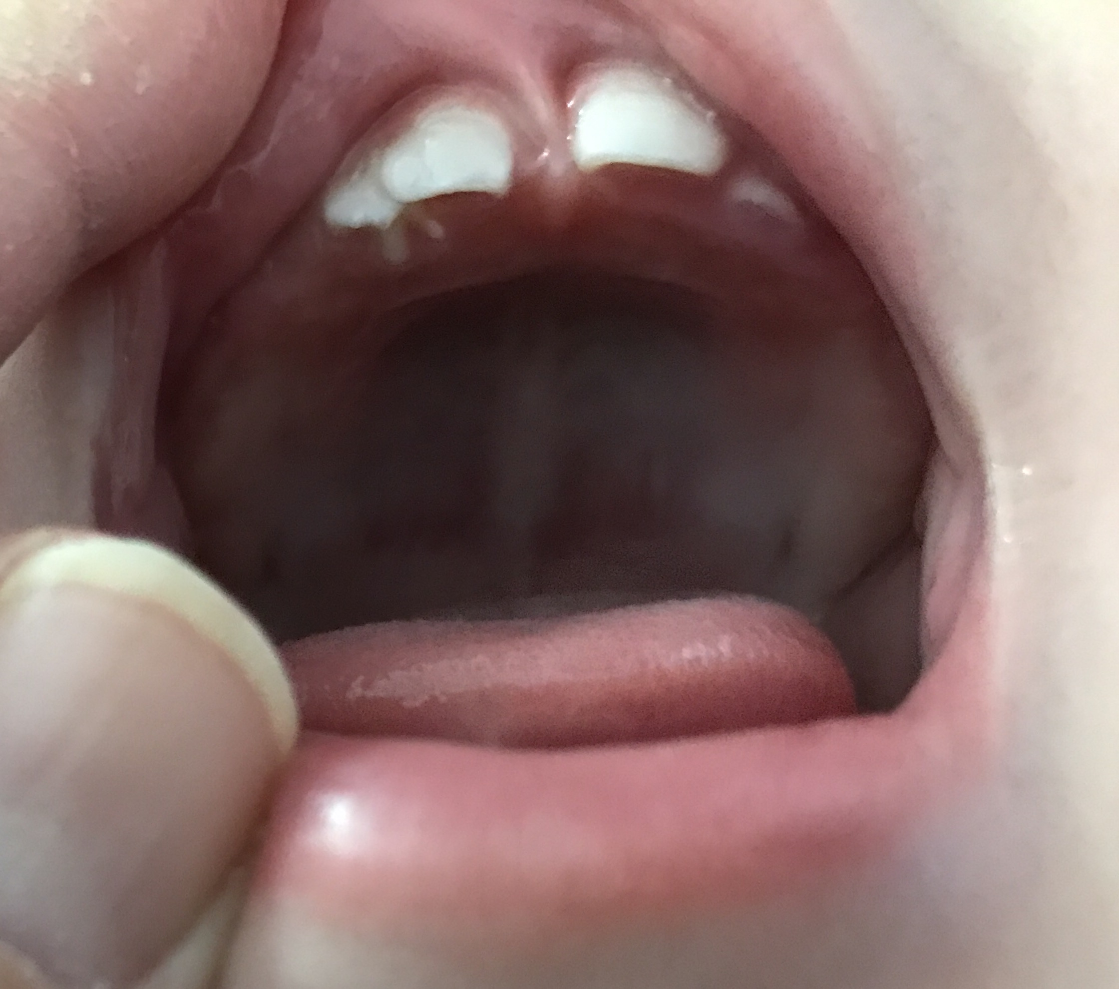 写真あり 生後９ヶ月 前歯が重なって生えてきました 歯チャンネル歯科相談室