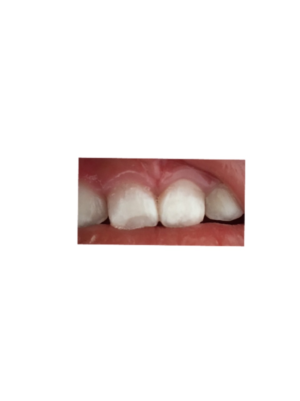 写真あり ２歳 乳歯の前歯の白濁 歯チャンネル歯科相談室