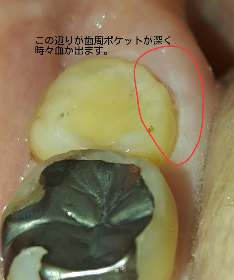 写真あり 智歯周囲炎の症状に似ているが先生からは指摘されない 歯チャンネル歯科相談室