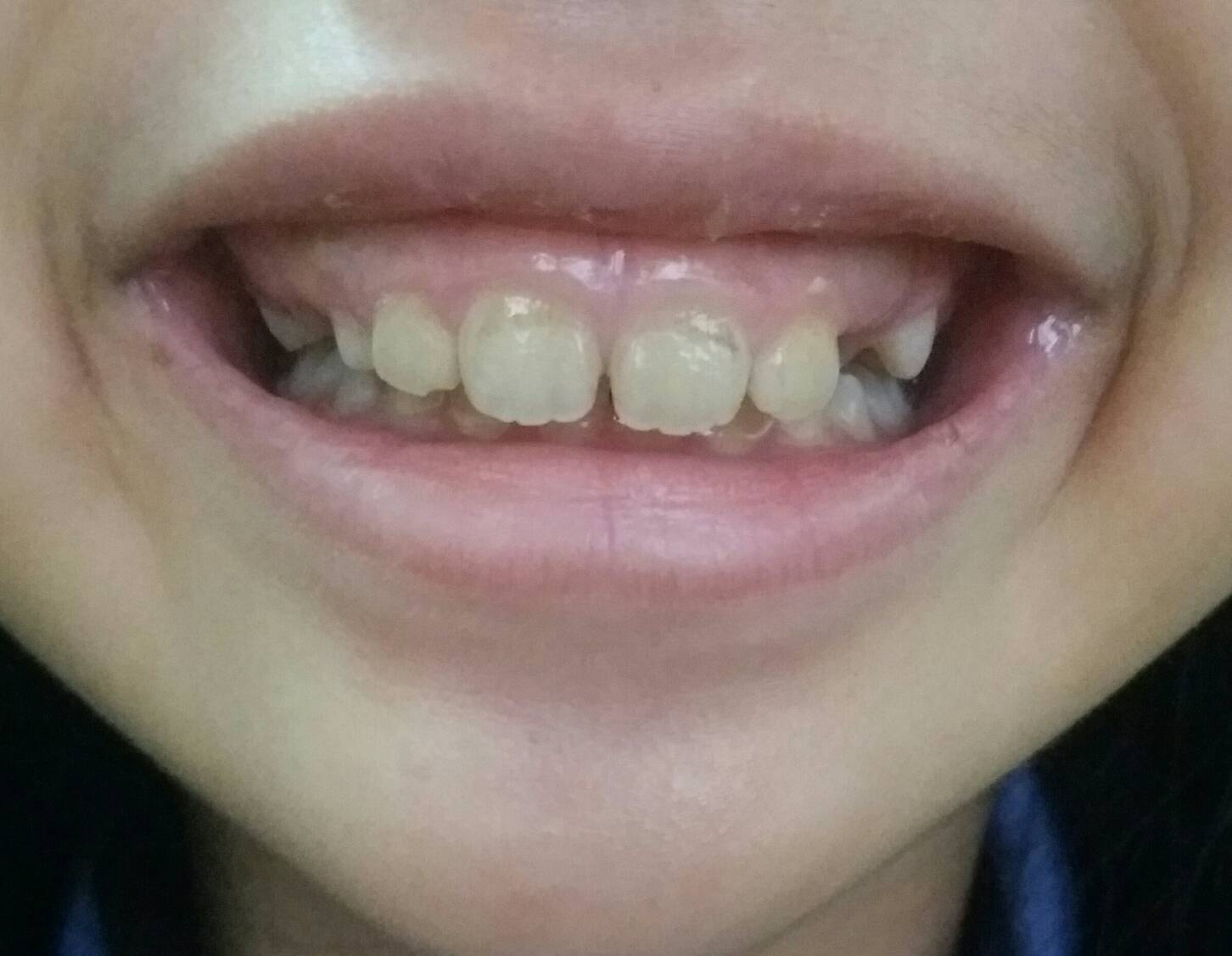 写真あり １１歳 隙間のある歯並びと笑うと歯茎が見えるのが気になる 歯チャンネル歯科相談室