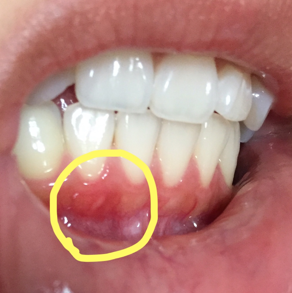 歯茎 の 腫れ 口内炎