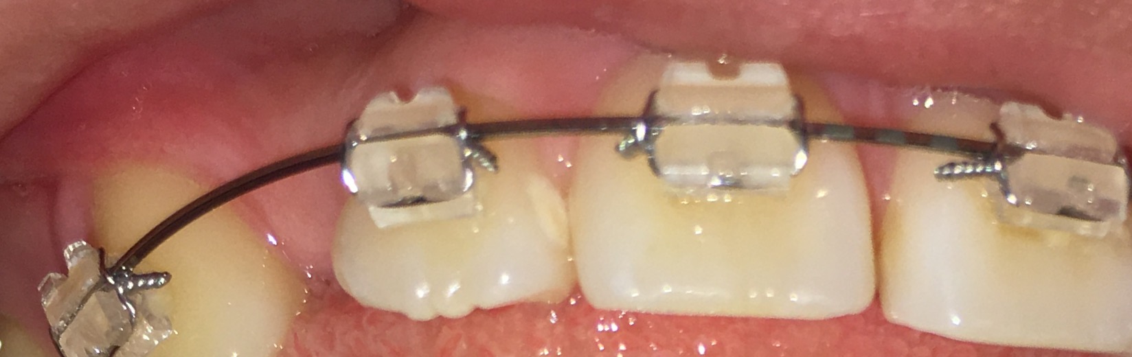 写真あり 歯列矯正中 歯の表面の白い斑点が気になります 歯チャンネル歯科相談室