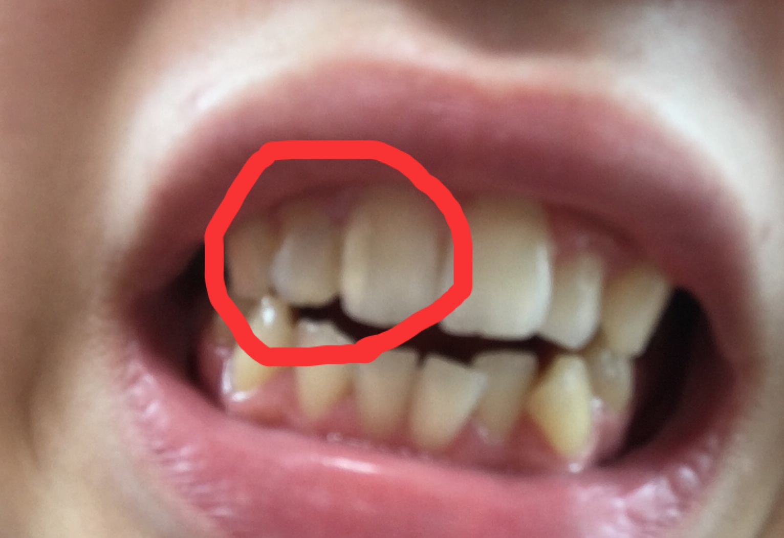 写真あり 2週間前に 前歯の虫歯治療をしてもらったところが汚い 歯チャンネル歯科相談室