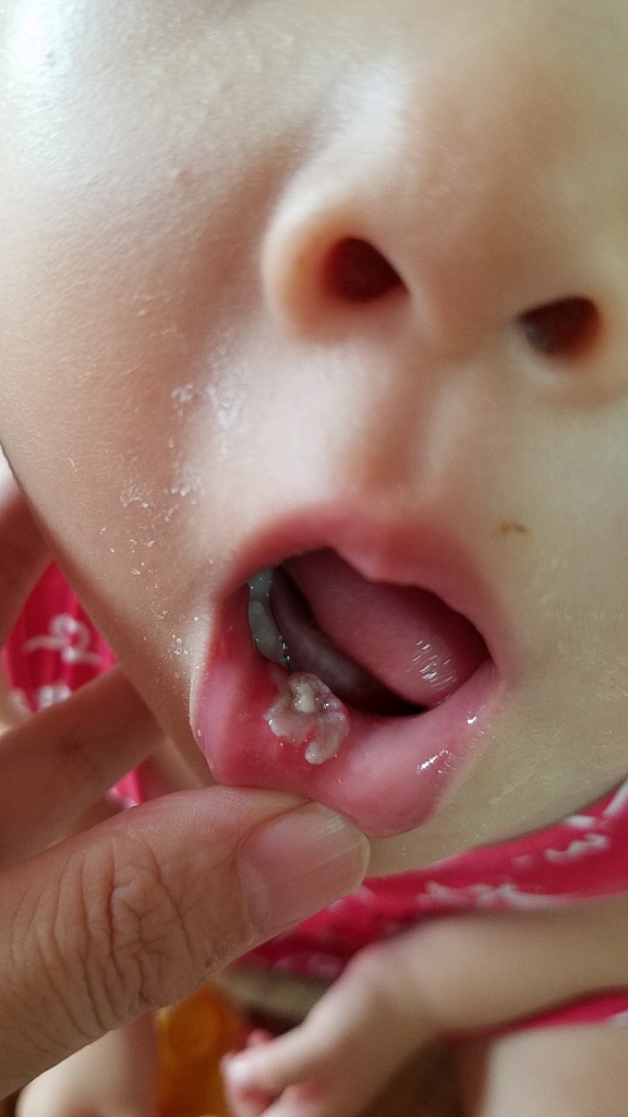 写真あり ２歳 口の中を切り下唇の裏に白いものが出来て心配 歯チャンネル歯科相談室