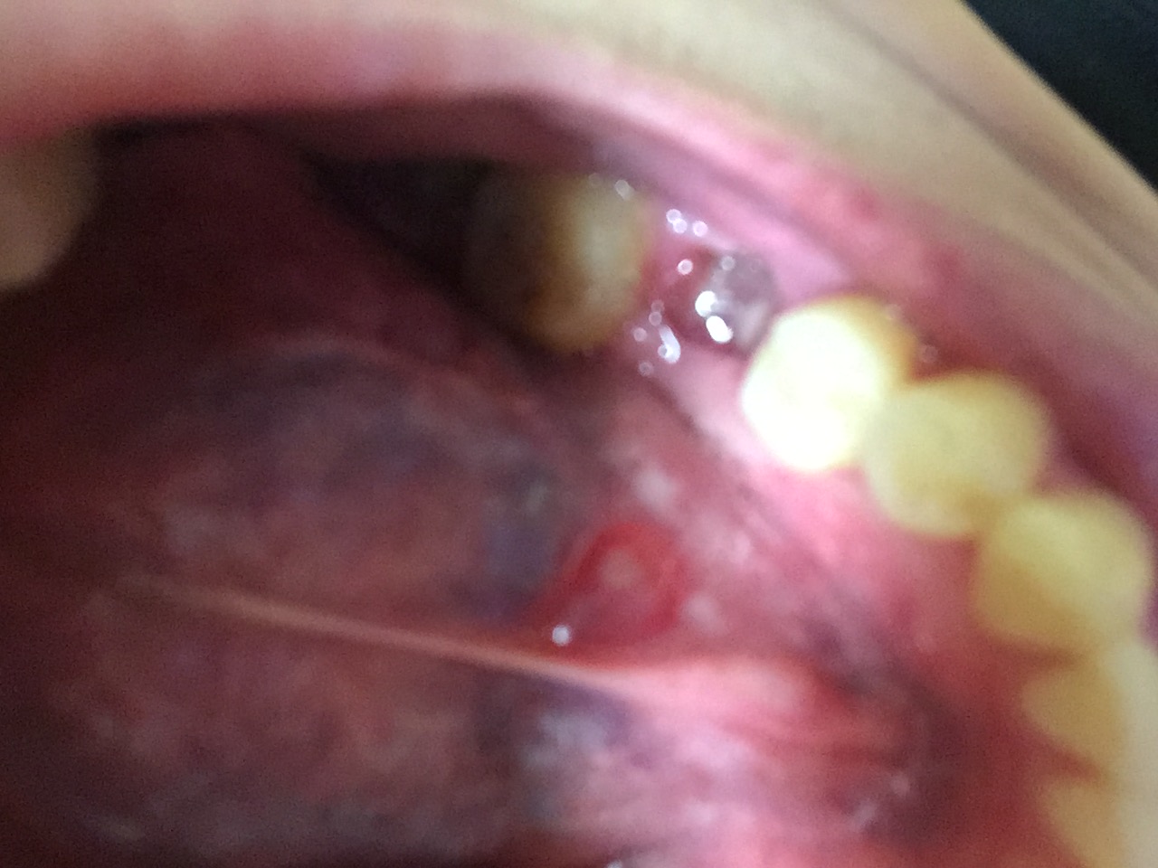 写真あり 舌の裏に硬くて赤いできもの 口内炎ですか 歯チャンネル歯科相談室