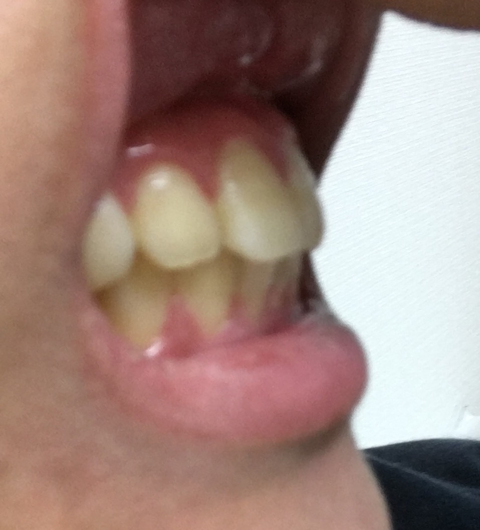 写真あり 私は出っ歯 歯列矯正で外国人のように綺麗な口元になるか 歯チャンネル歯科相談室