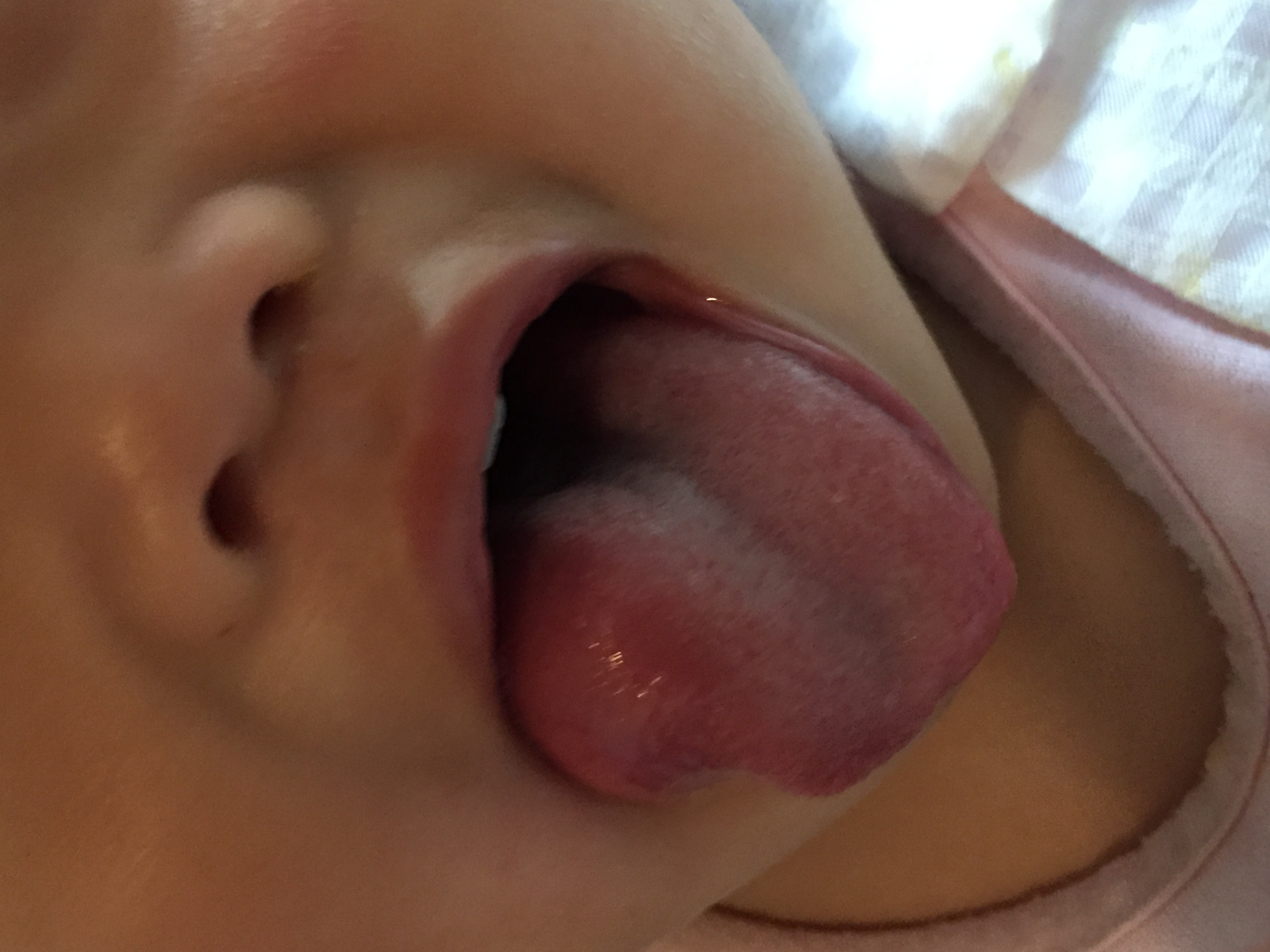写真あり １歳 舌側面の赤紫色のできもの 歯チャンネル歯科相談室