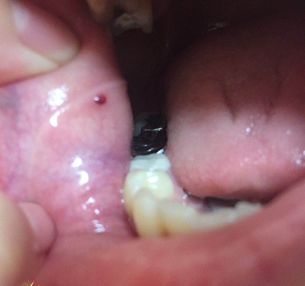 写真あり 歯科受診後に口内を見たら頬内側に血豆 歯チャンネル歯科相談室