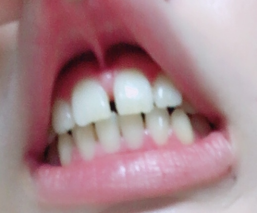 [写真あり] 正中離開があり上唇小帯切除が必要か？ 歯チャンネル歯科相談室