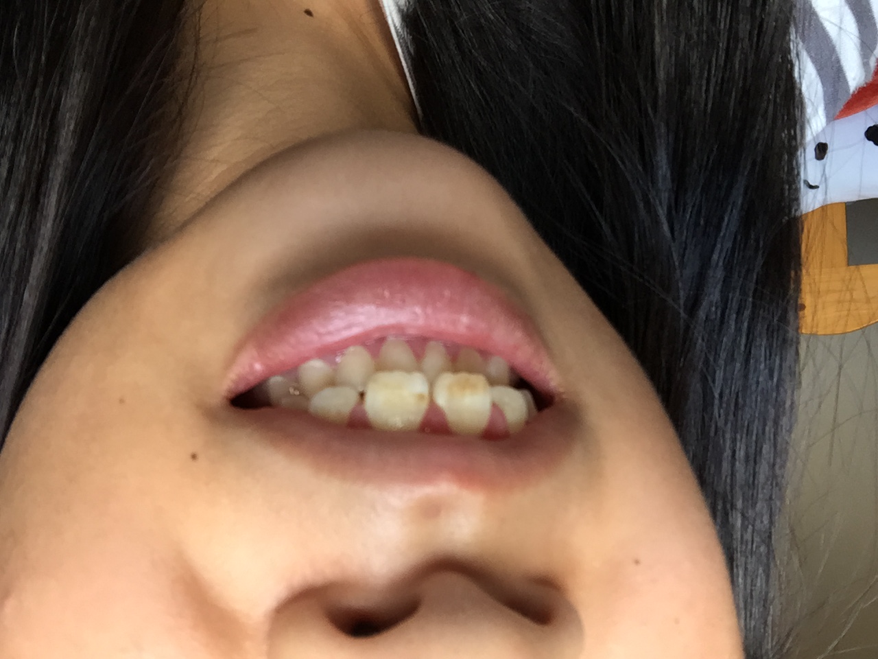 [写真あり] 前歯が黄色いのは治らないのでしょうか？ 歯チャンネル歯科相談室