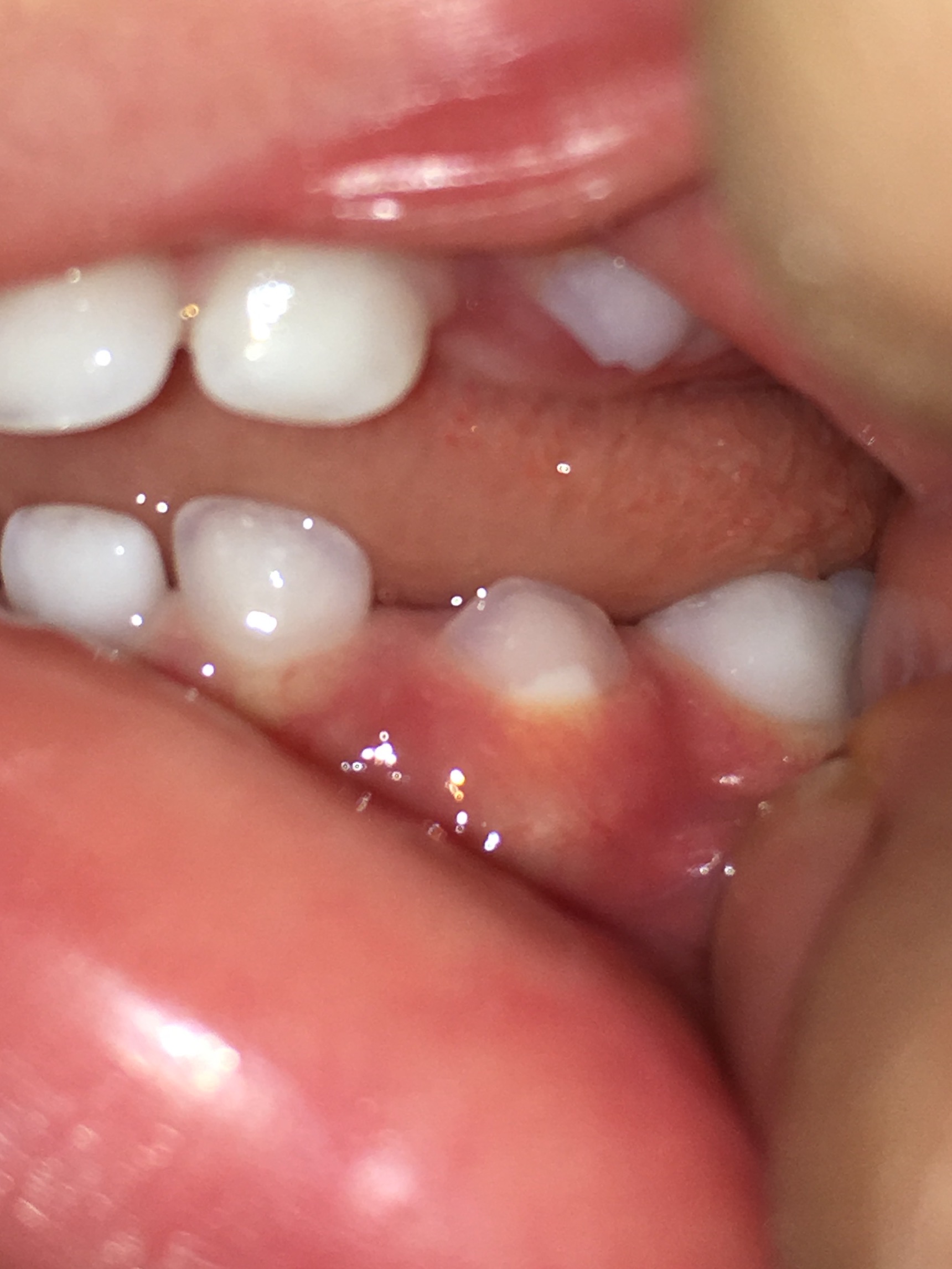 １歳４ヵ月 生えて10日程度の乳歯の根元が白い 歯チャンネル歯科相談室