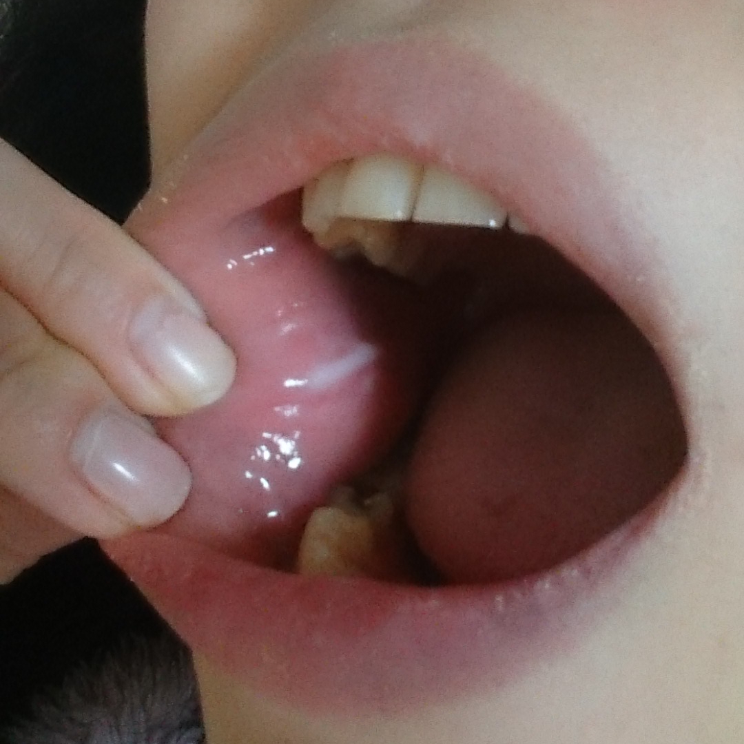 写真あり 頬の内側を噛む癖のせいで頬粘膜が筋のように白い 歯チャンネル歯科相談室