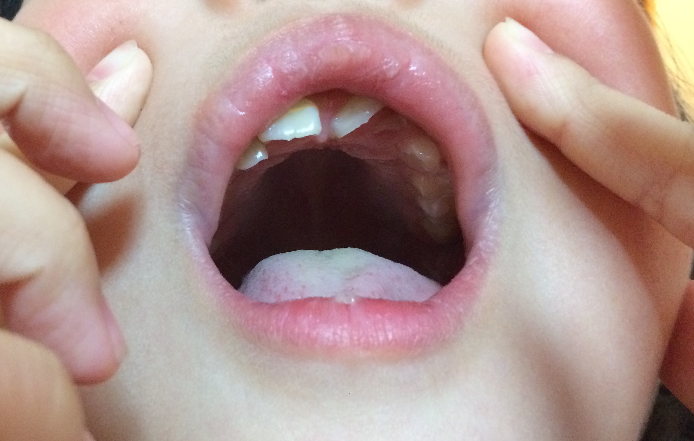 写真あり ７歳 斜めに生えてきた右上前歯の後ろに白い歯のようなもの 歯チャンネル歯科相談室