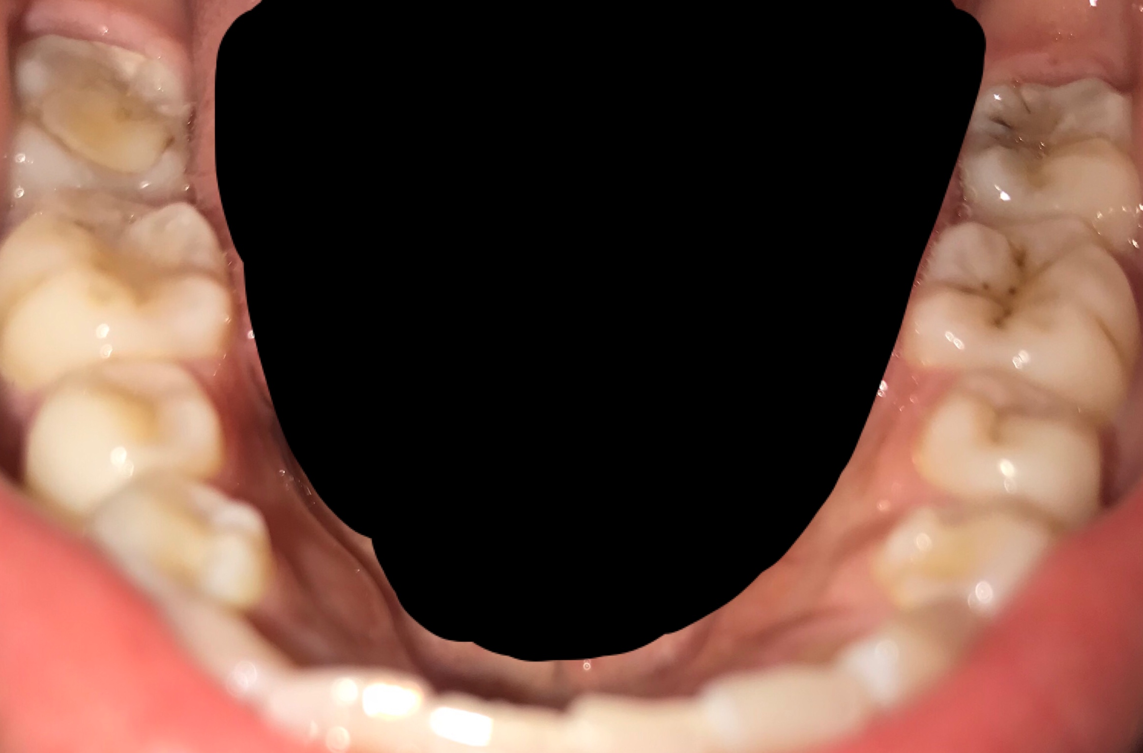 写真あり 奥歯の黒いものは虫歯でしょうか 歯チャンネル歯科相談室
