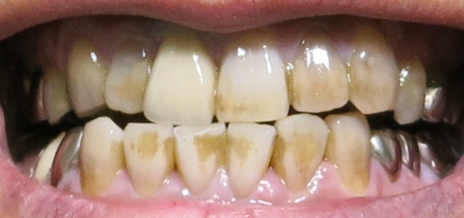写真あり 前歯についた茶色が気になっている 歯チャンネル歯科相談室
