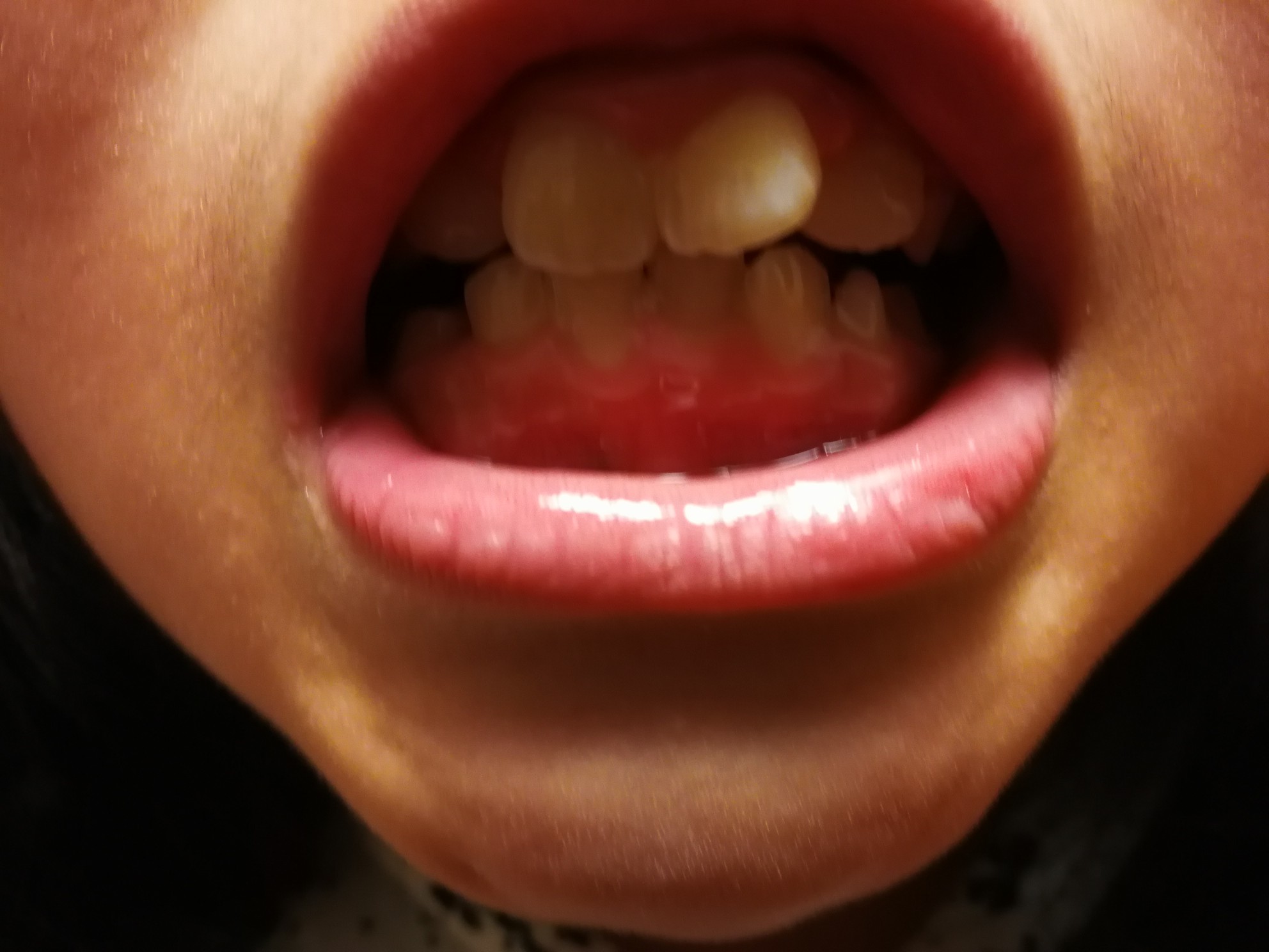 写真あり 9歳 前歯が片方だけ斜めに生えております 歯チャンネル歯科相談室