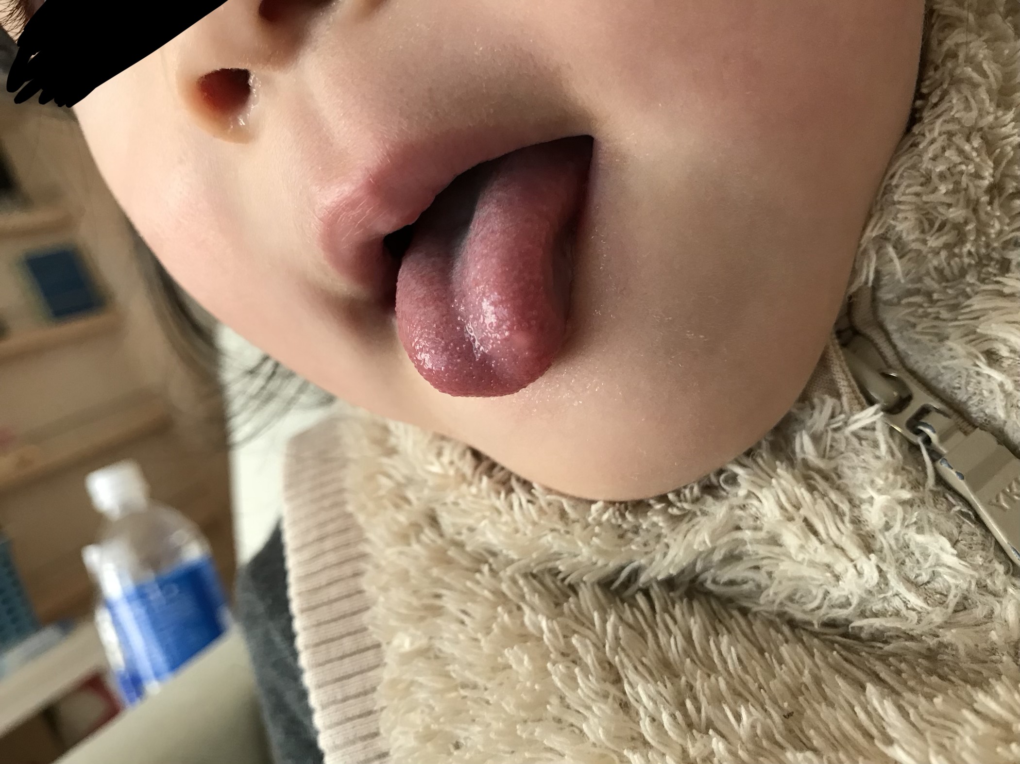 写真あり ３歳 舌に生まれつきある白いできものについて 歯チャンネル歯科相談室