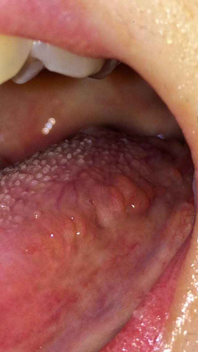 写真あり 舌の左側縁にデコボコした出来物 歯チャンネル歯科相談室