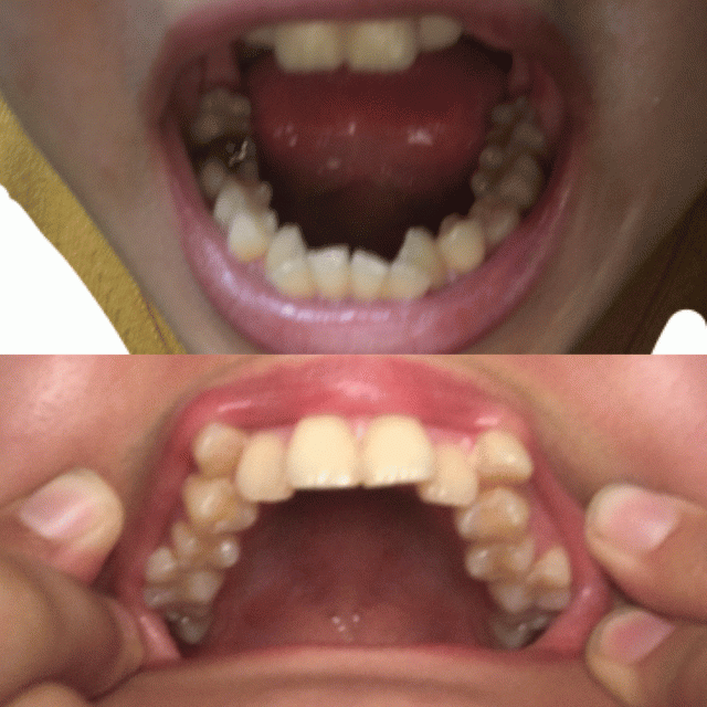 写真あり 歯列矯正を検討 期間や抜歯や骨格の変形について 歯チャンネル歯科相談室