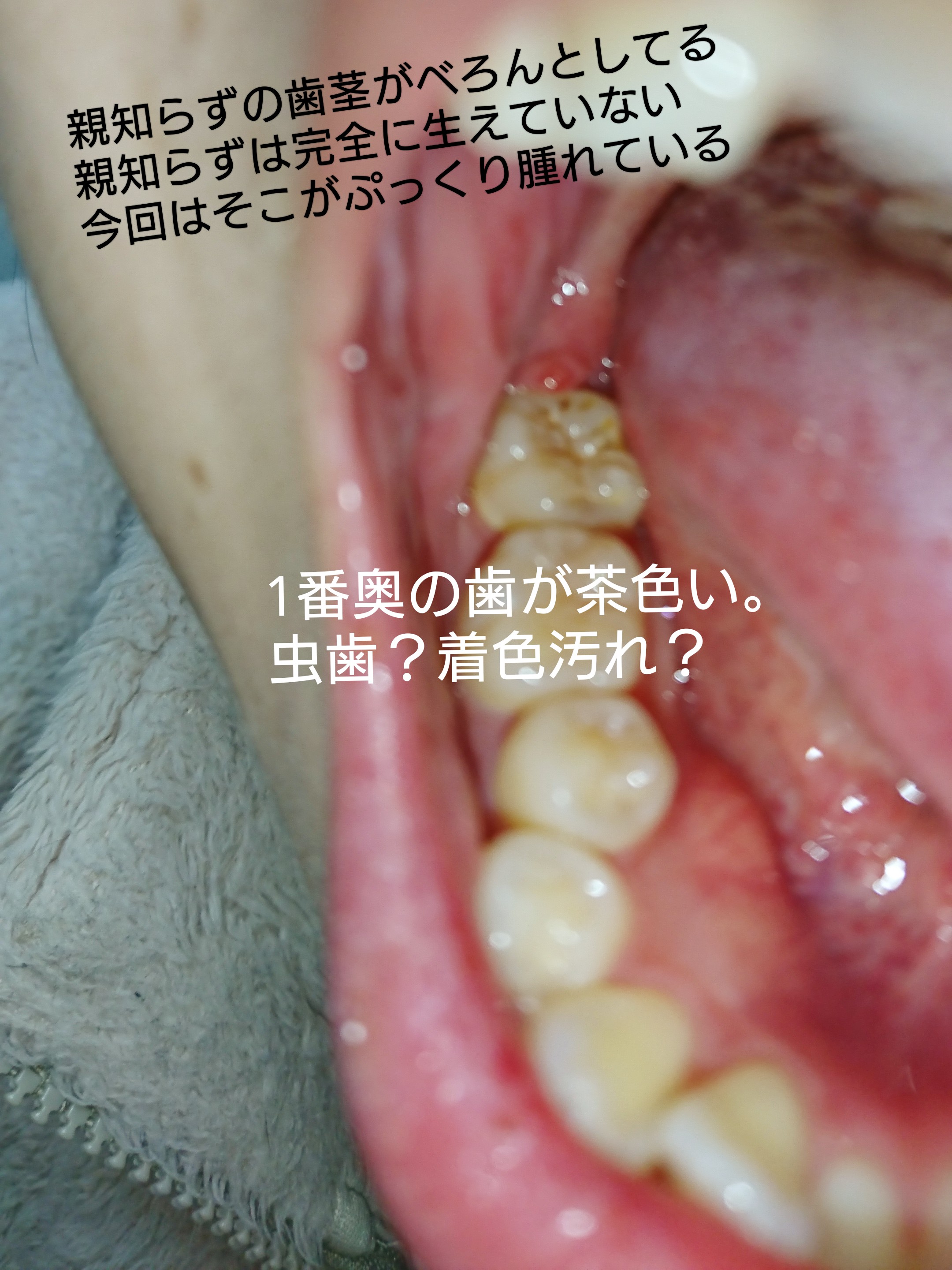 が 腫れる 奥 の 歯茎