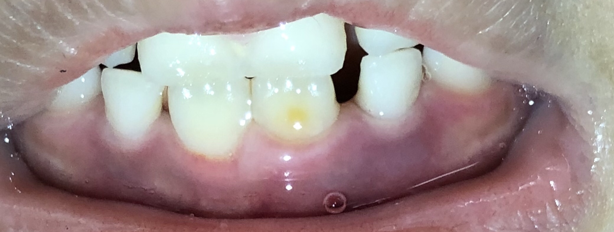 写真あり 子供の前歯が生え替わったら永久歯に黄色の斑点がある 歯チャンネル歯科相談室