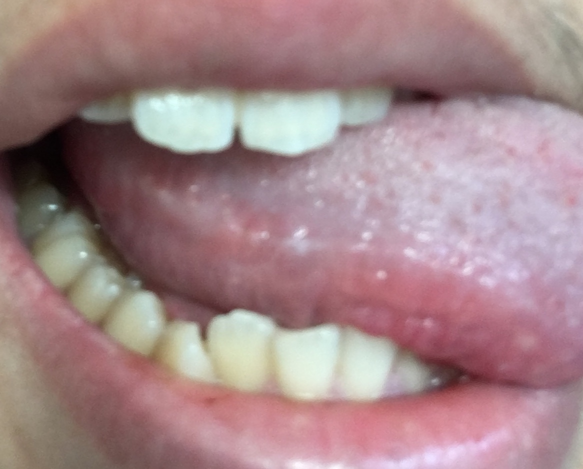 写真あり 5日ほど前から舌に白いできもの 歯チャンネル歯科相談室