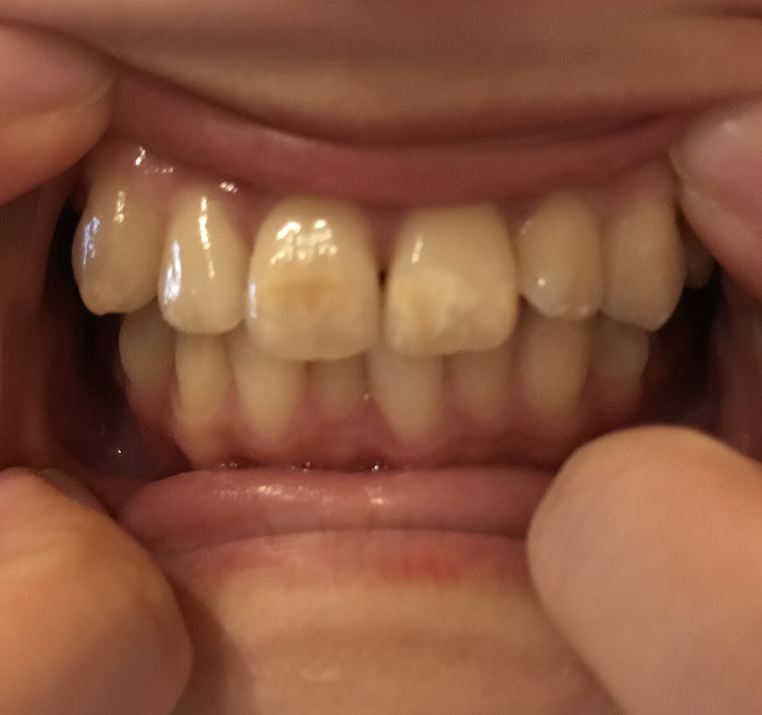 写真あり 生まれつき歯全体が黄色く 前歯の変色も何とかしたい 歯チャンネル歯科相談室