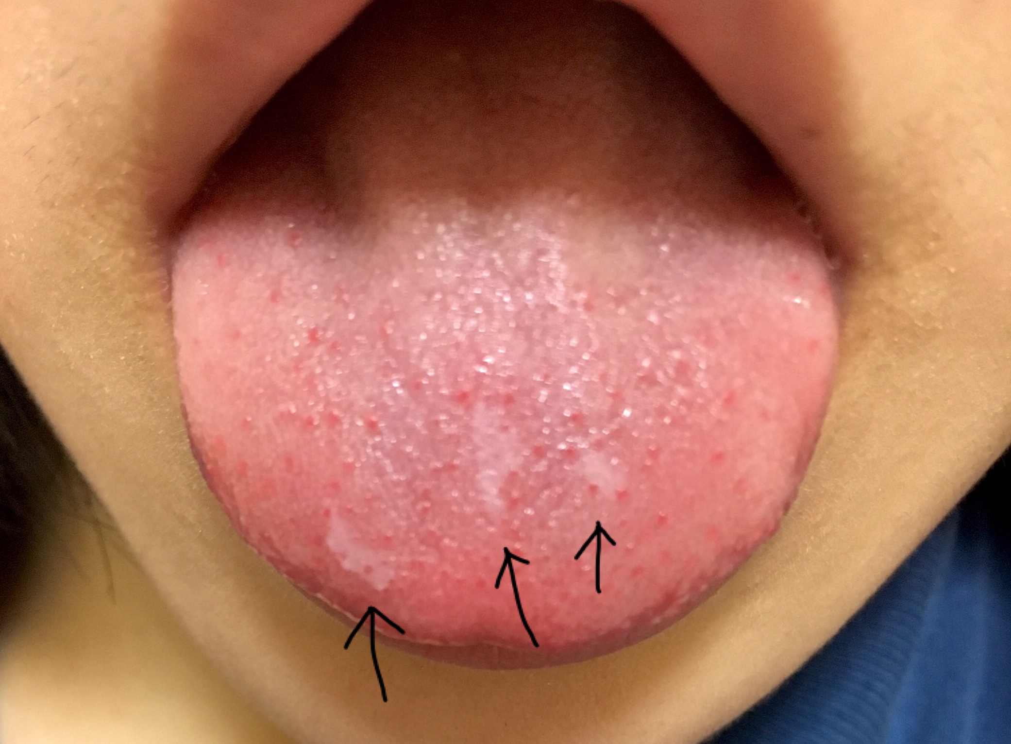 写真あり 舌の表面に白い皮 歯チャンネル歯科相談室