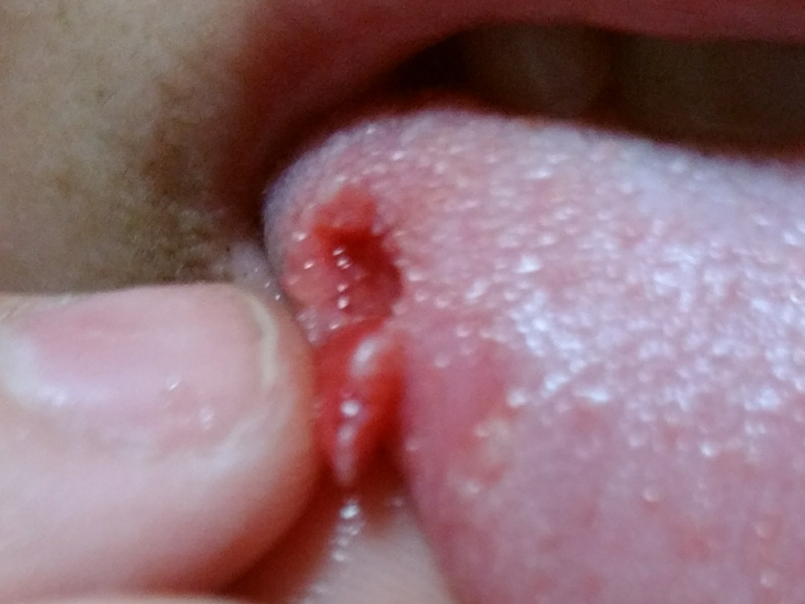 噛ん 痛い 舌 だ 舌が痛いのは、なぜ？ 見た目では分からない【舌痛症】との見分け方