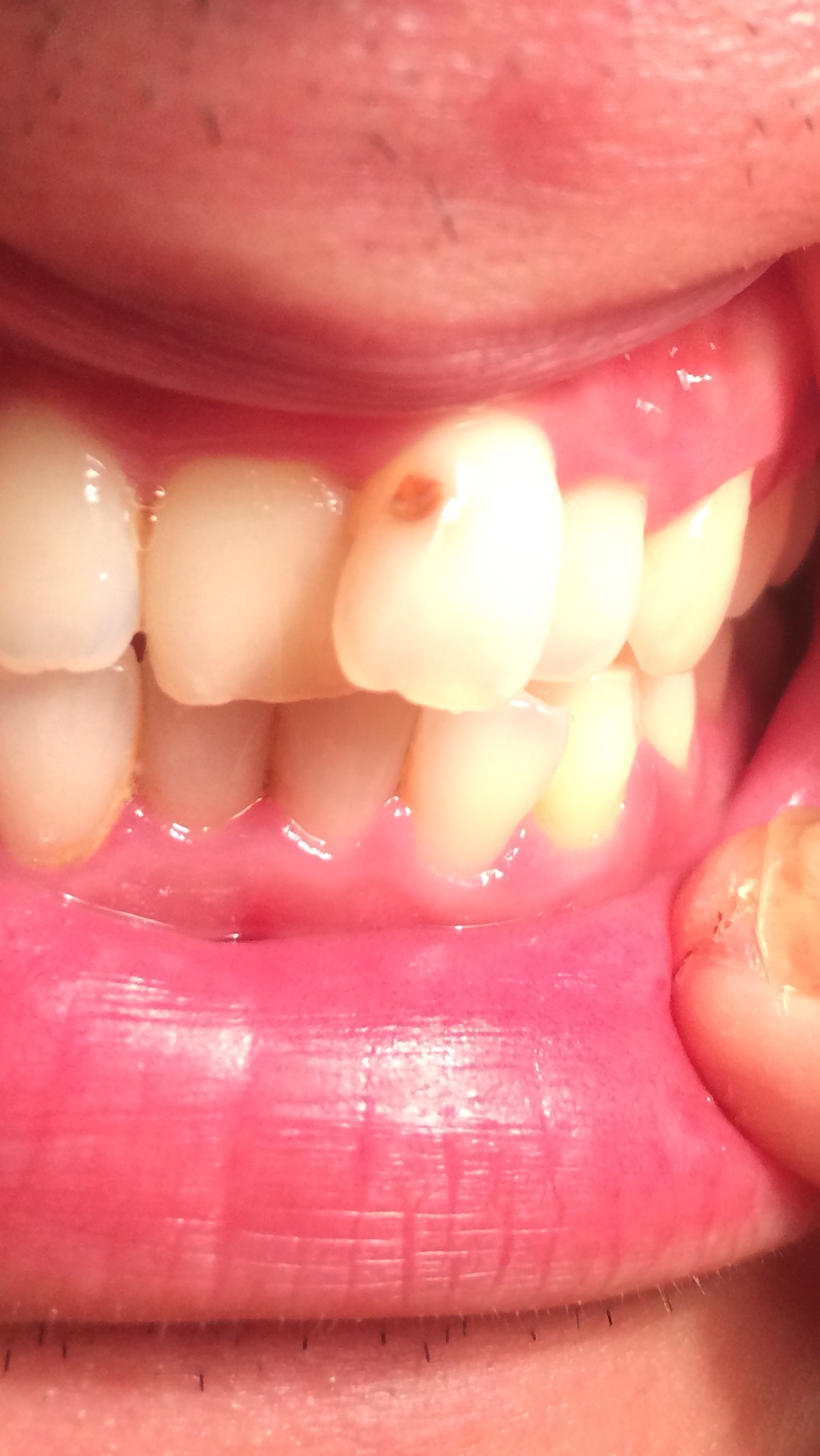 写真あり 前歯に茶色の傷のような穴 虫歯ですか 第三者より 歯チャンネル歯科相談室