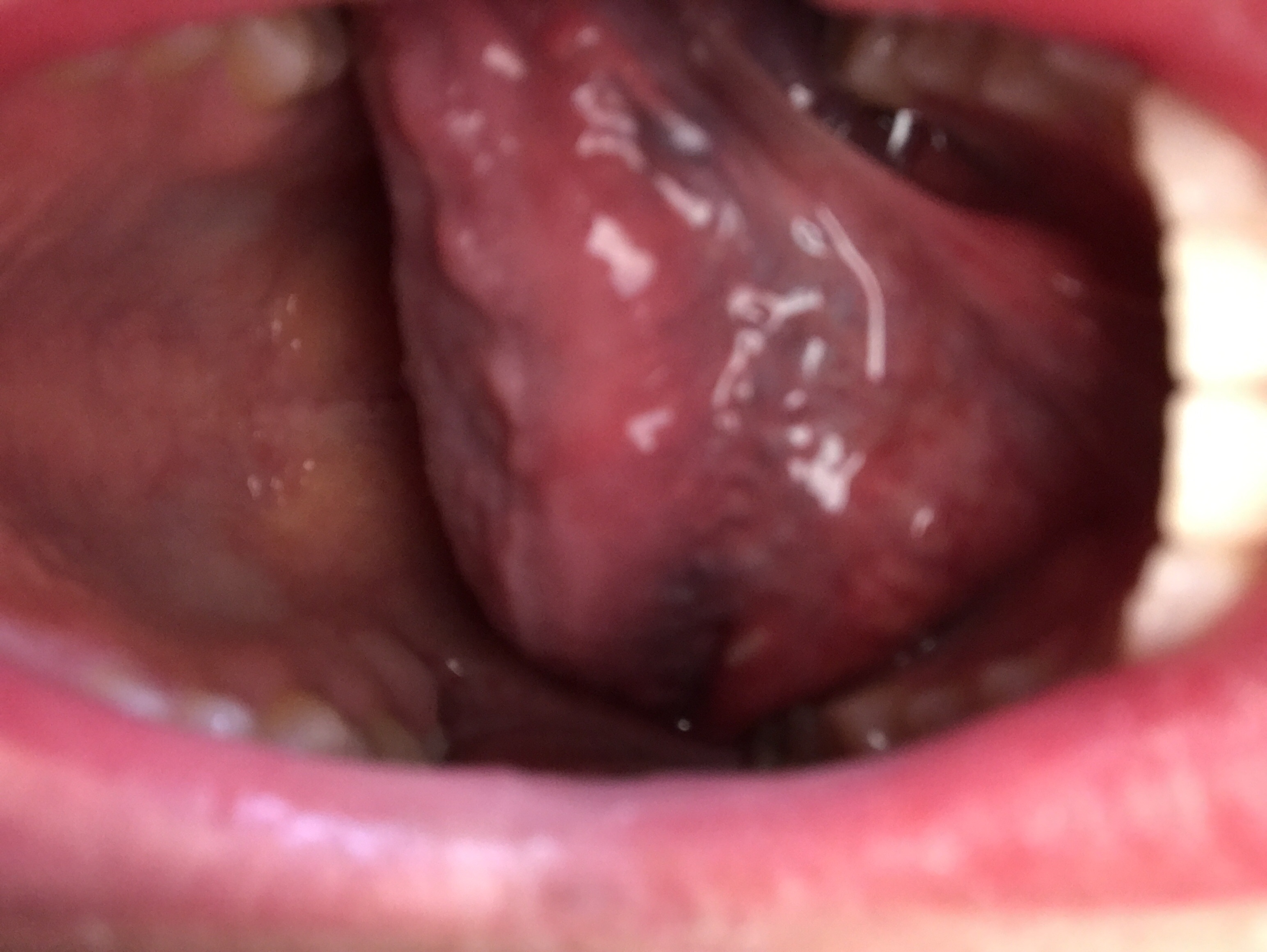 写真あり 舌の裏の白い斑点と痛み 舌癌ではないですか 歯チャンネル歯科相談室