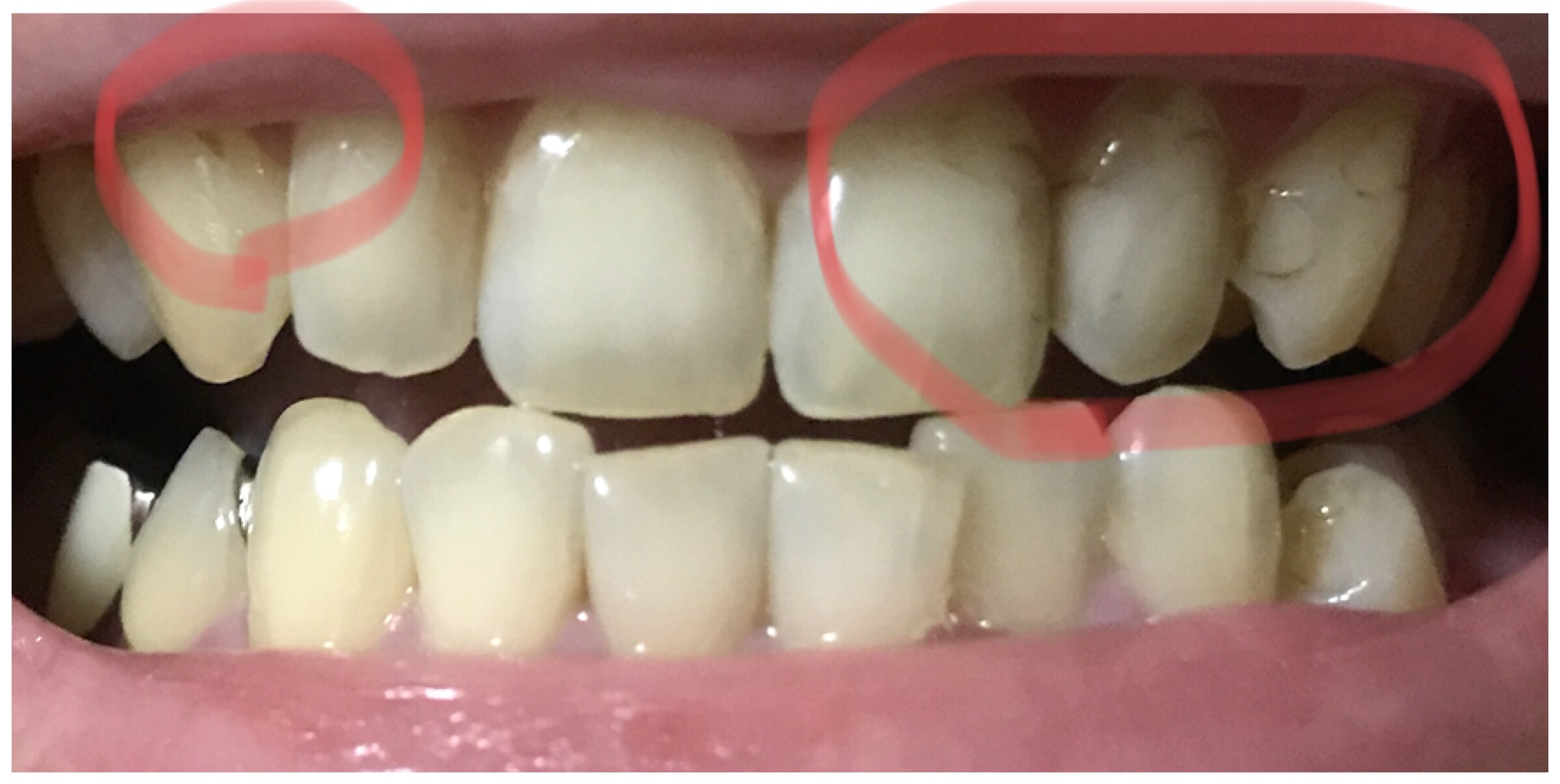 写真あり 前歯の治療した箇所の茶色い線が気になる 歯チャンネル歯科相談室