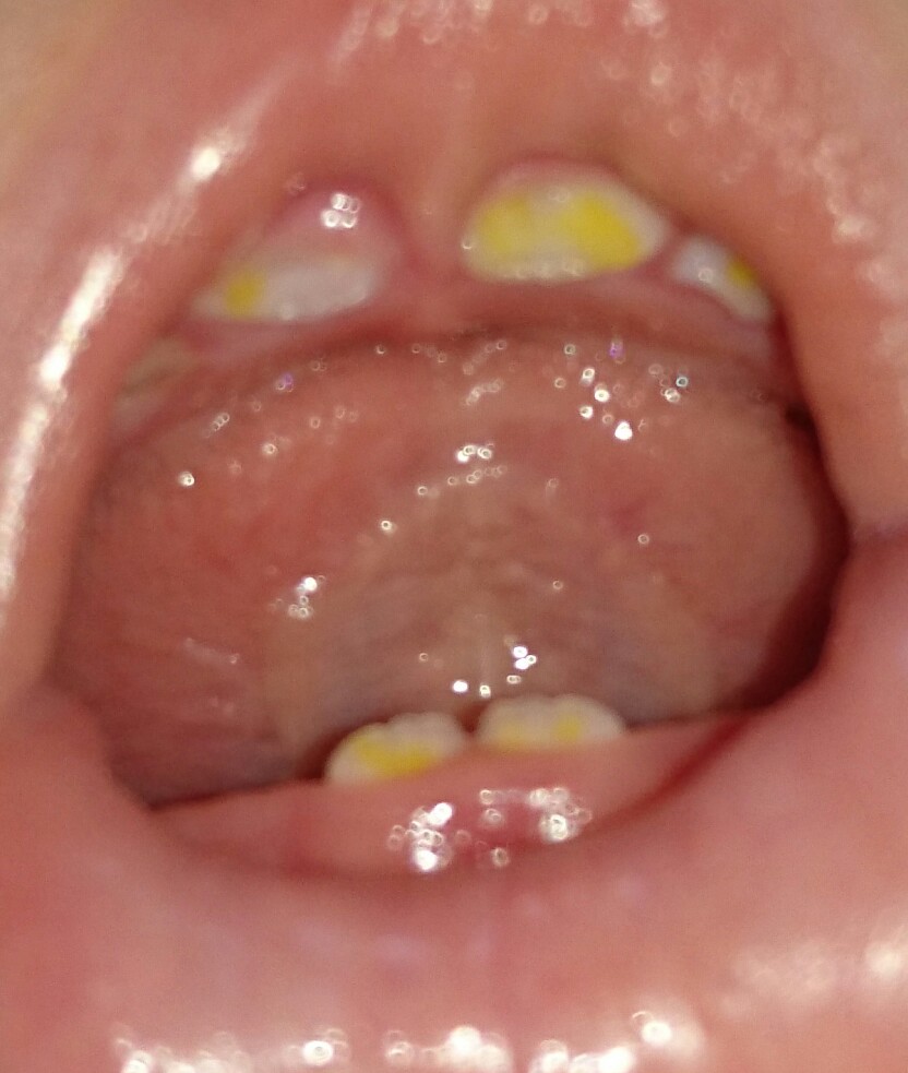 写真あり 生後七ヶ月の生え始めの歯が黄色い 歯チャンネル歯科相談室