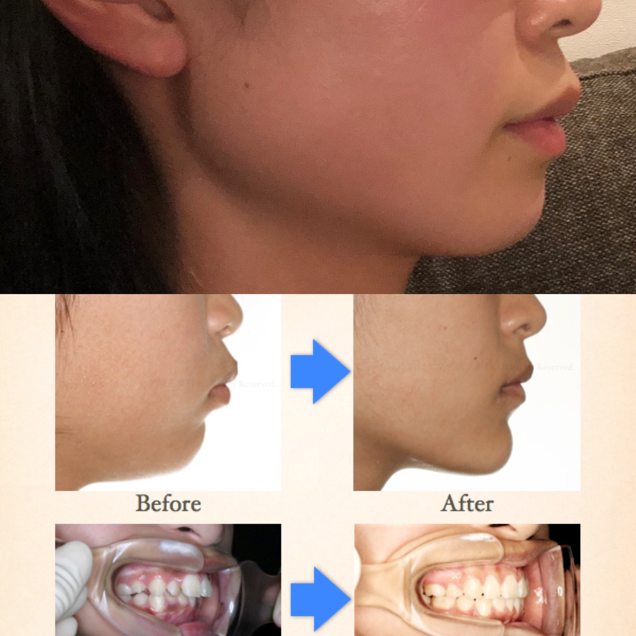 写真あり 上下顎前突気味 歯列矯正での横顔の変化について 歯チャンネル歯科相談室