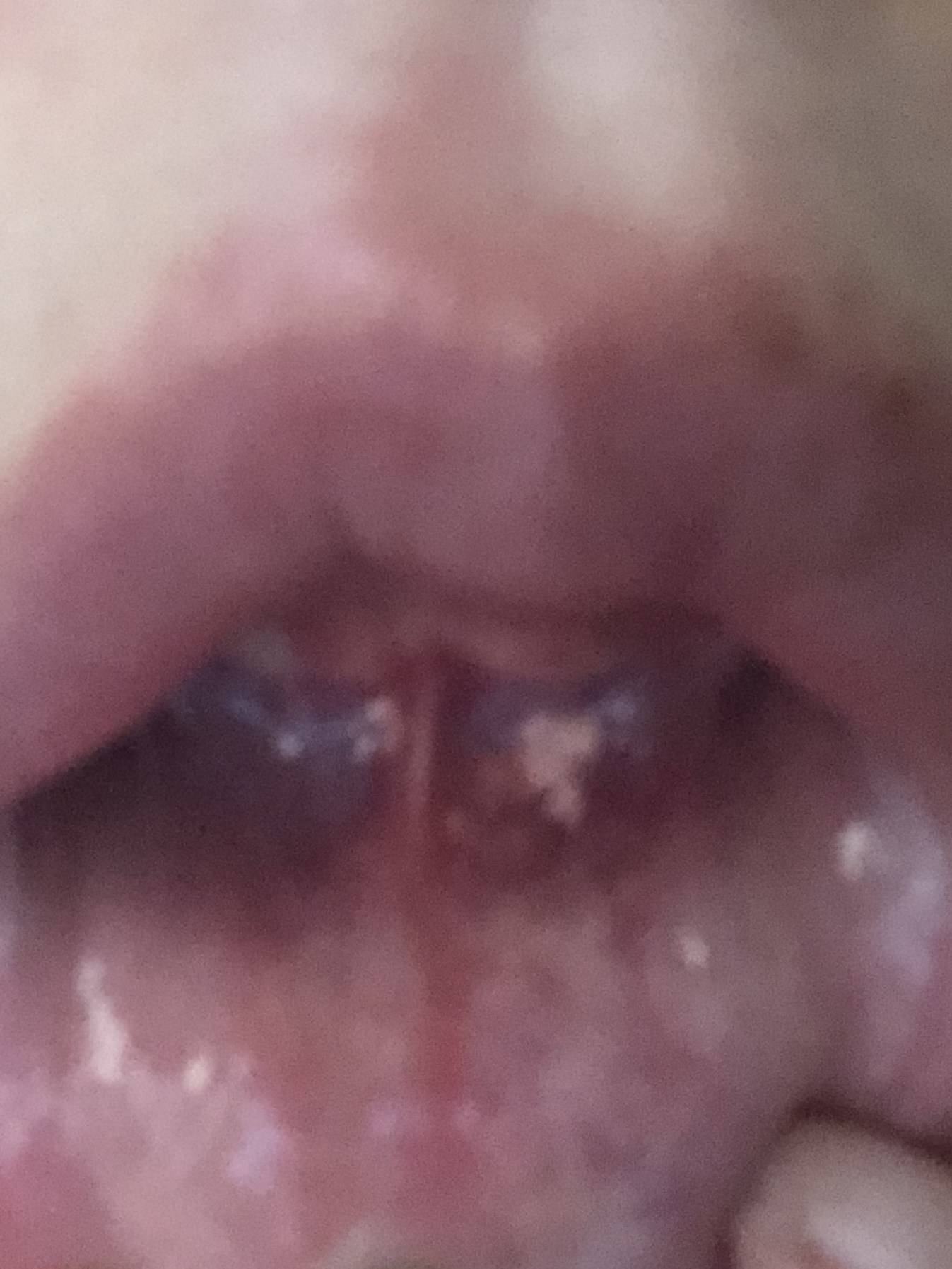 写真あり 下唇の根元の皮膚下に黄色いっぽいブツブツしたもの 歯チャンネル歯科相談室