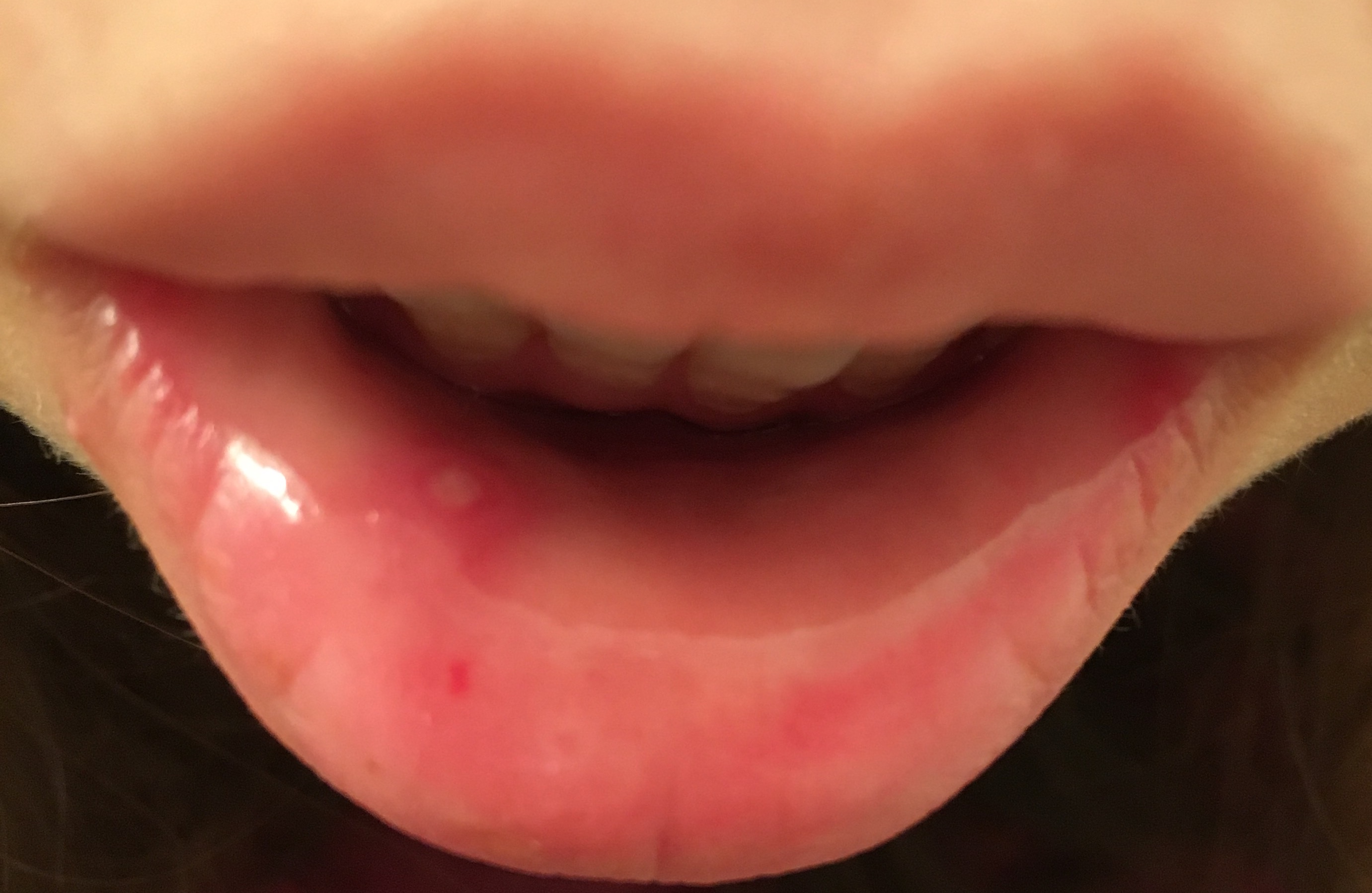 写真あり 下唇粘膜の紅い斑点 紅板症ではないかと心配 歯チャンネル歯科相談室