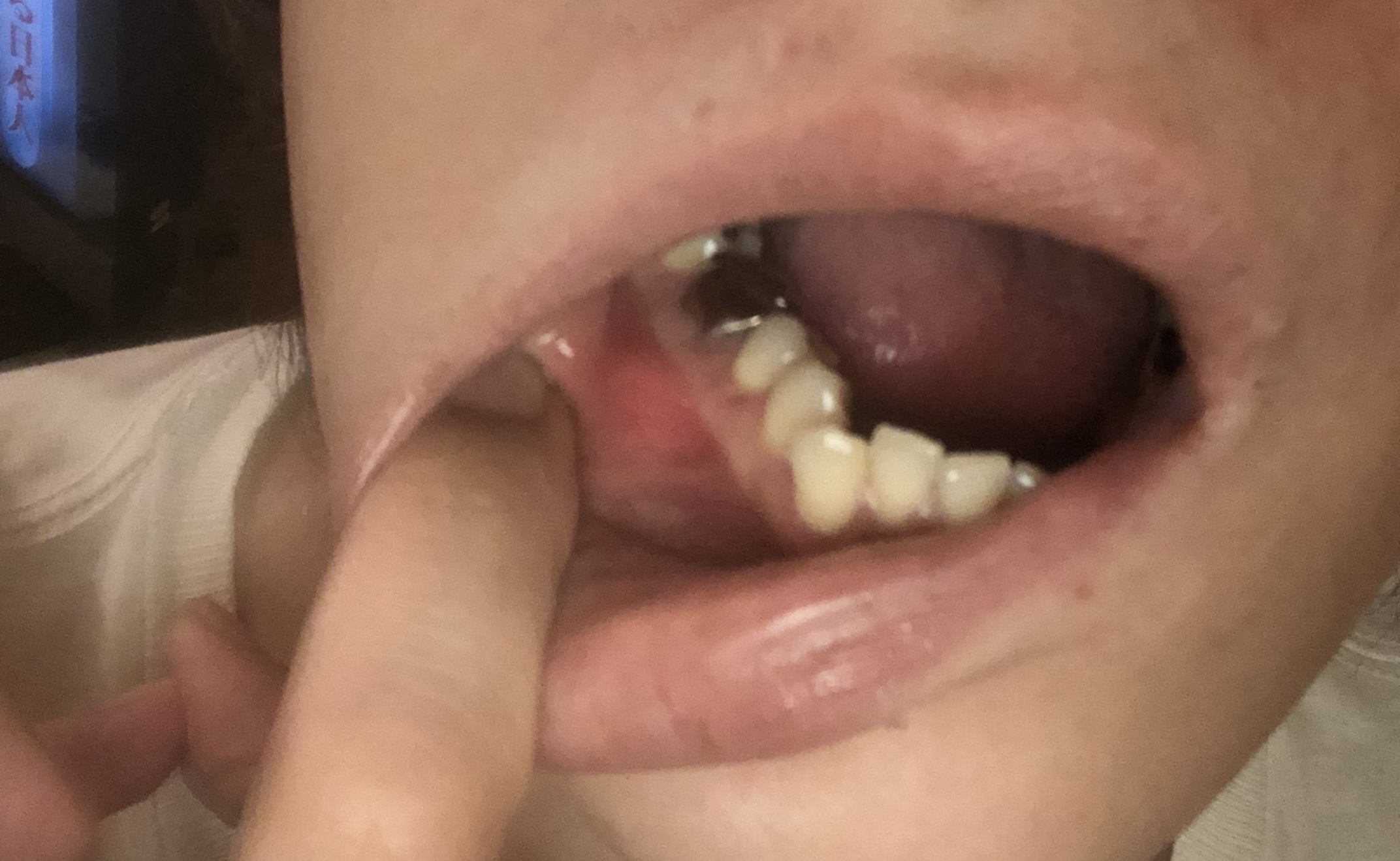 [写真あり] 1ヶ月前から 痛みはないが右下歯茎外側に固いしこり
