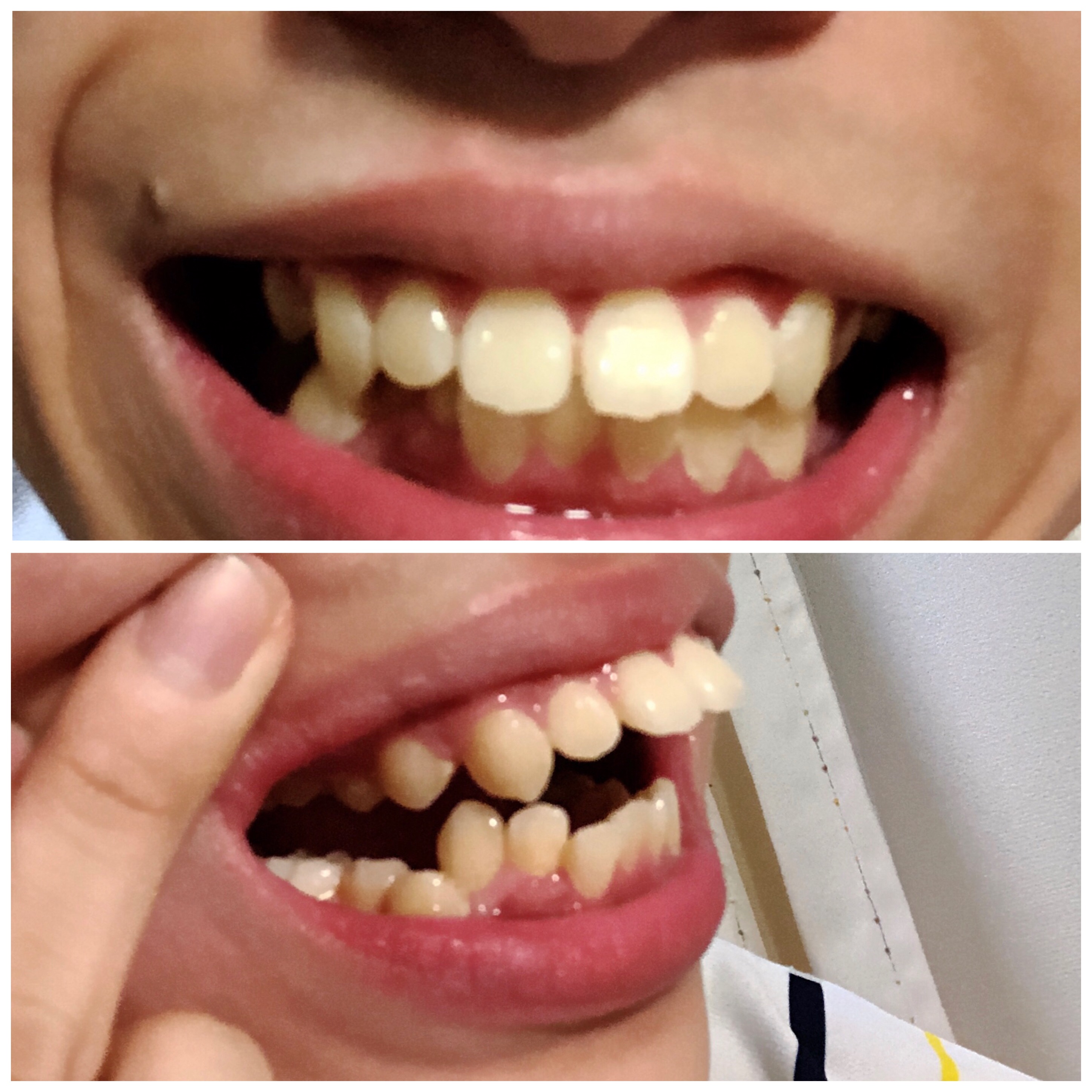 写真あり 出っ歯と歯並びの矯正は外科手術なしに出来ますか 歯チャンネル歯科相談室