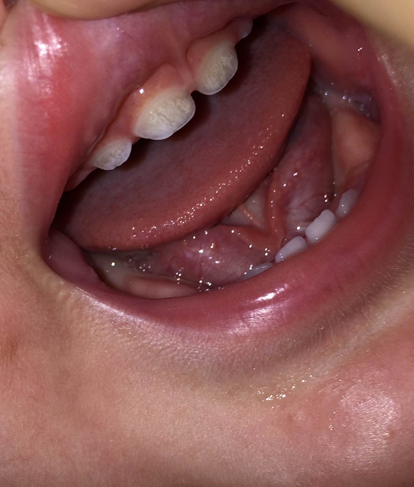 写真あり 1歳1ヶ月 前歯の着色は虫歯でしょうか 歯チャンネル歯科相談室