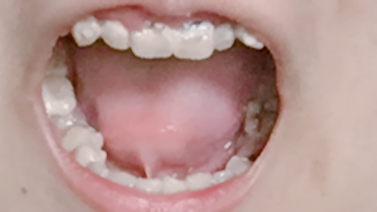 写真あり １８歳 全部虫歯から綺麗な歯になりたいが歯医者が怖い 歯チャンネル歯科相談室