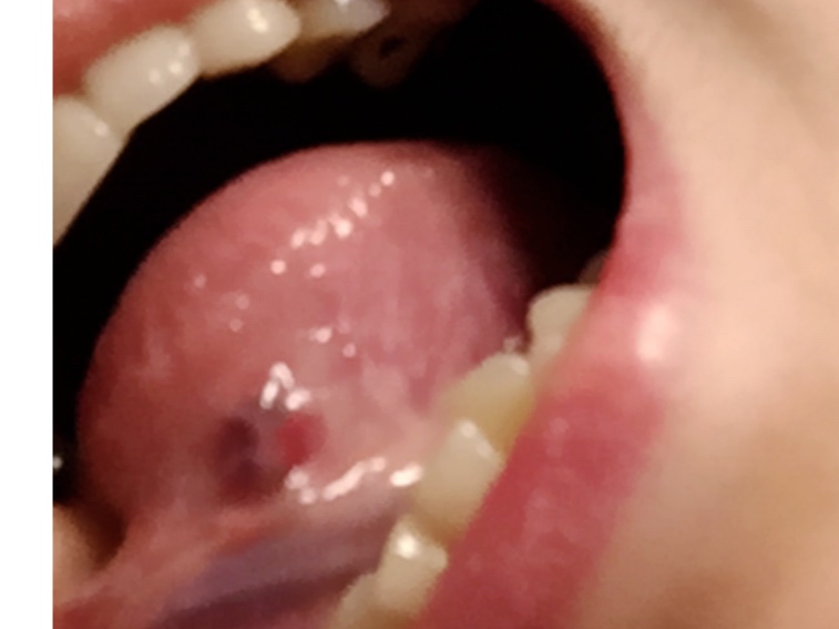写真あり 舌の裏の黒いしこりの様な出来物が心配です 歯チャンネル歯科相談室