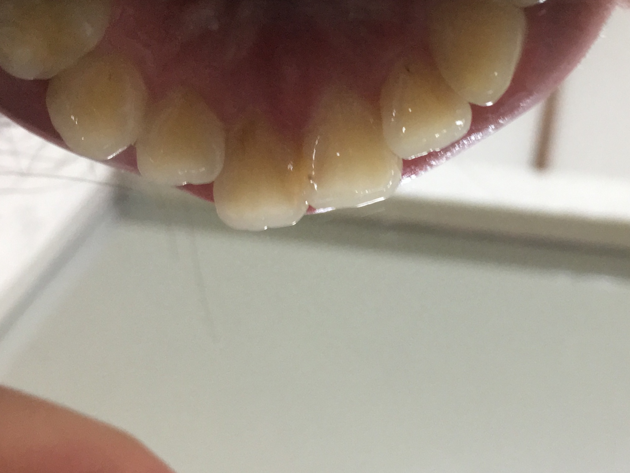 写真あり 前歯裏が薄茶色 これは虫歯ですか 歯チャンネル歯科相談室